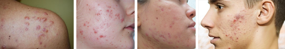 cheloidi cicatrici post acne