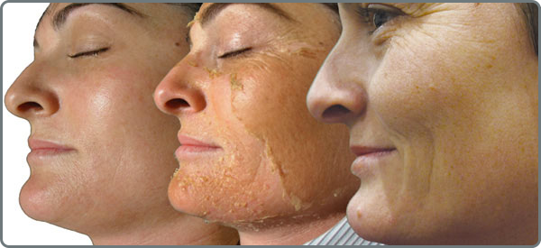 trattamento peeling