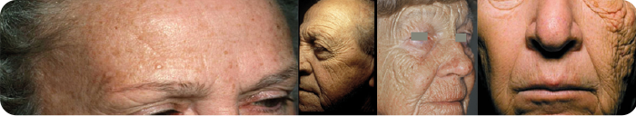 cheloidi cicatrici post acne