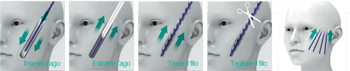 Procedura per la tecnica classica di applicazione dei Fili in PDO COG